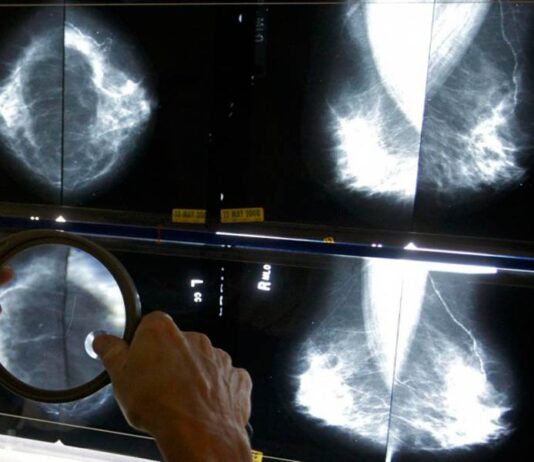 Tumore al seno, prevenire salva la vita. L’importanza dello screening mammografico